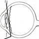 Secondary Posterior Chamber Intraocular Lens (PCIOL)